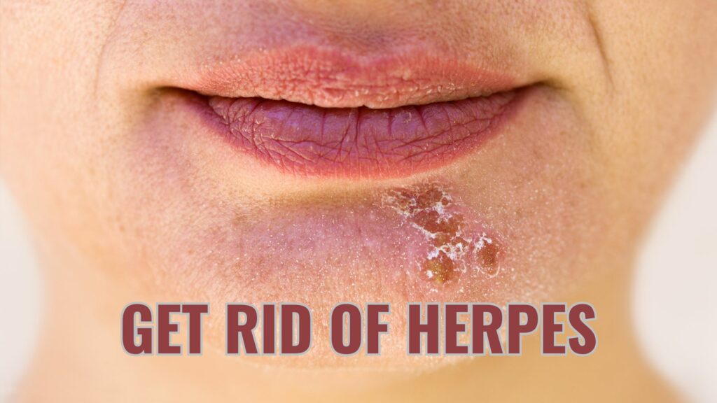 GET RID OF HERPES